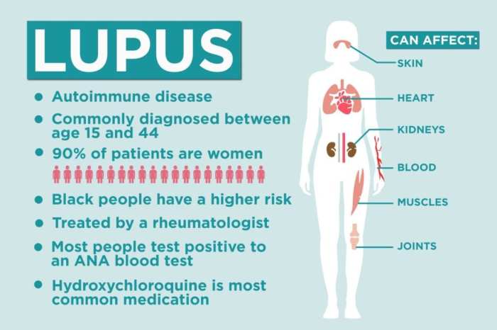 Sjogren's syndrome and lupus screening quiz