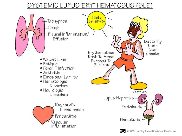 Sjogren's syndrome and lupus screening quiz